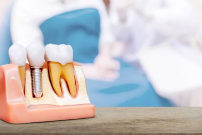 Odontología e Implantología: Los postgrados privados más rentables para dentistas
